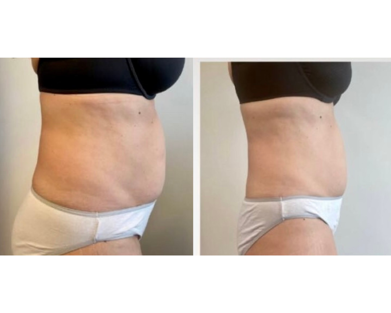 Foto van Cryo Shaping in Knokke-Heist — Schoonheidssalon (foto 3)