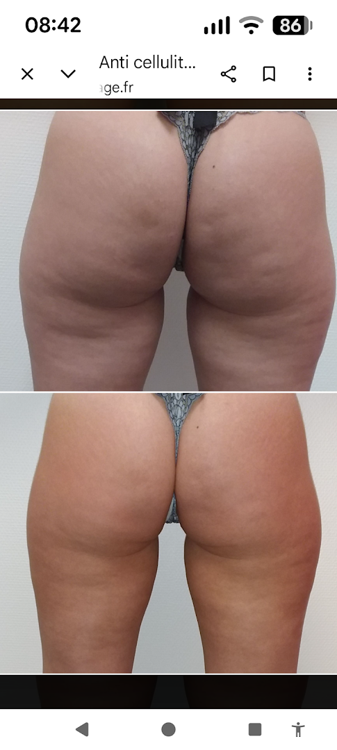 Foto van Endermologie Lpg Expert Center Forme & Santé: Anti-Cellulite · Sculpteur Corporel · Cryolipolyse in Bruxelles — Centrum voor gewichtsbeheersing (foto 3)