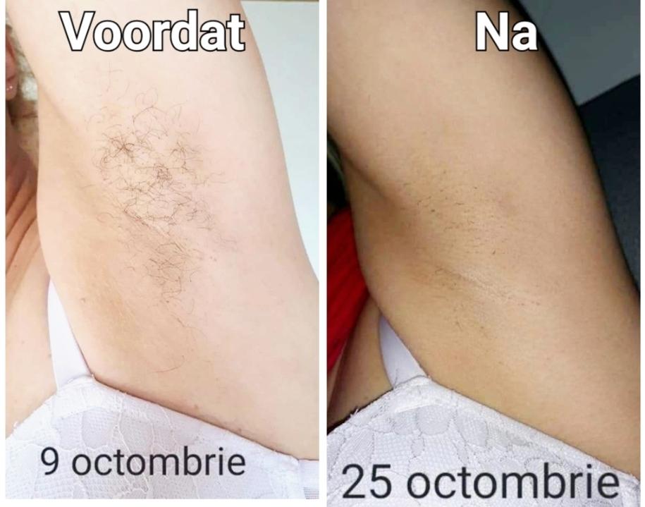 Foto van GINA Studio - LaserOntharing, Plasma Pen, Roeselare Schoonheidssalon in Roeselare — Ontharing met laser (foto 3)